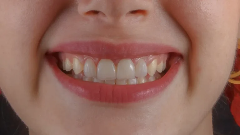 Woman smiling with healthy teeth showing benefits of Dental Insurance coverage