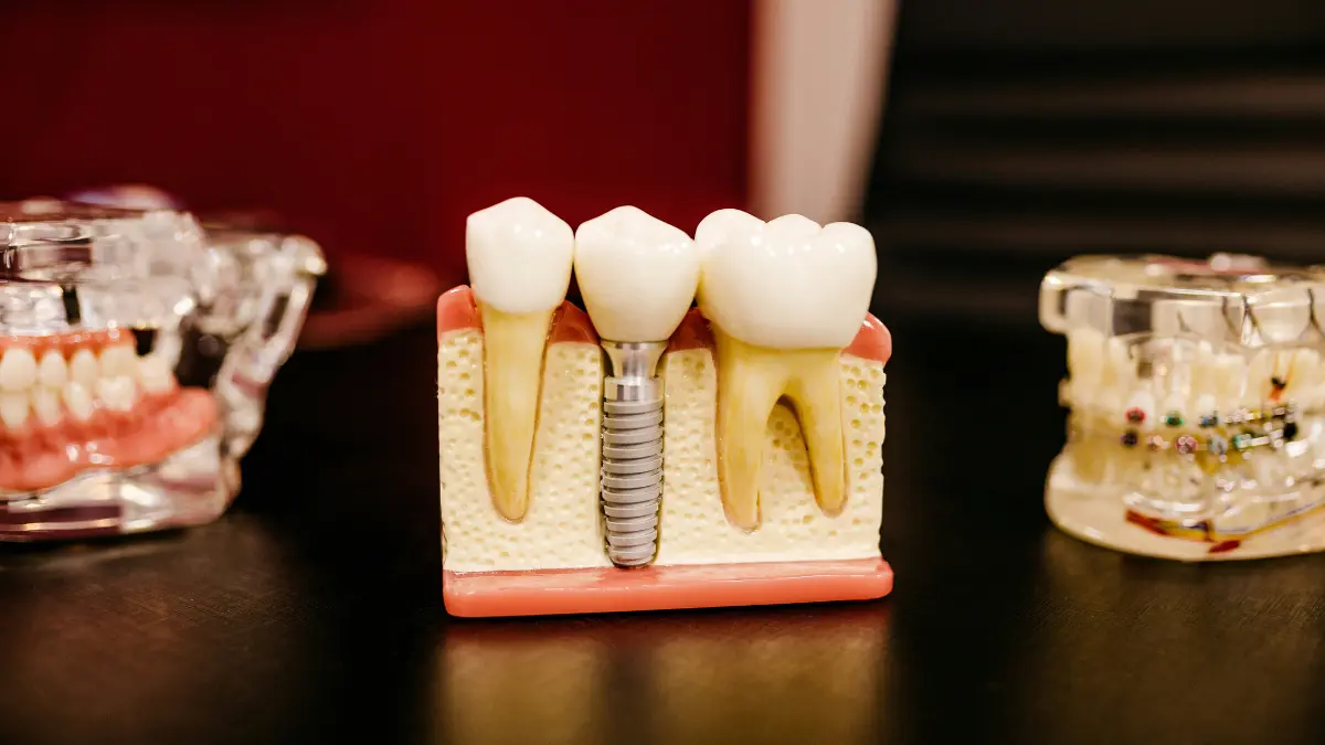 Dental insurance plans covering dental implant and major procedures cost in 2026